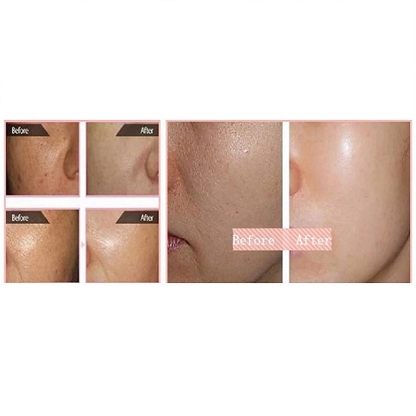 Hovedbilde QF-HA MESO SERUM NON-CROSS LINKED 1,5% 5ml