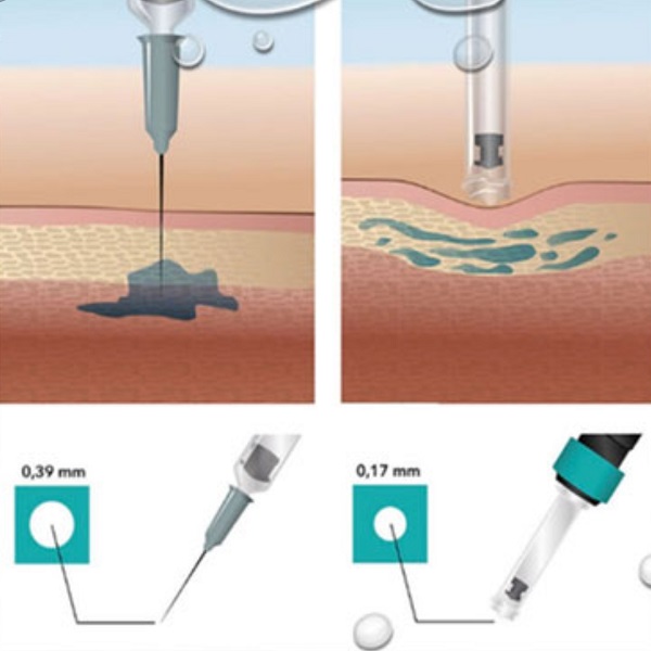 Bilde av CI-HYALAX BIFASISK 2,0% Hyaluronsyre Filler