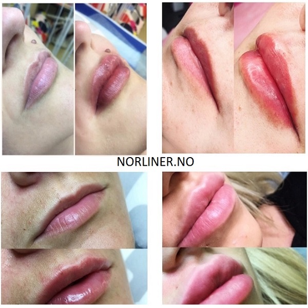 Bilde av CI-HYALAX BIFASISK 2,0% Hyaluronsyre Filler